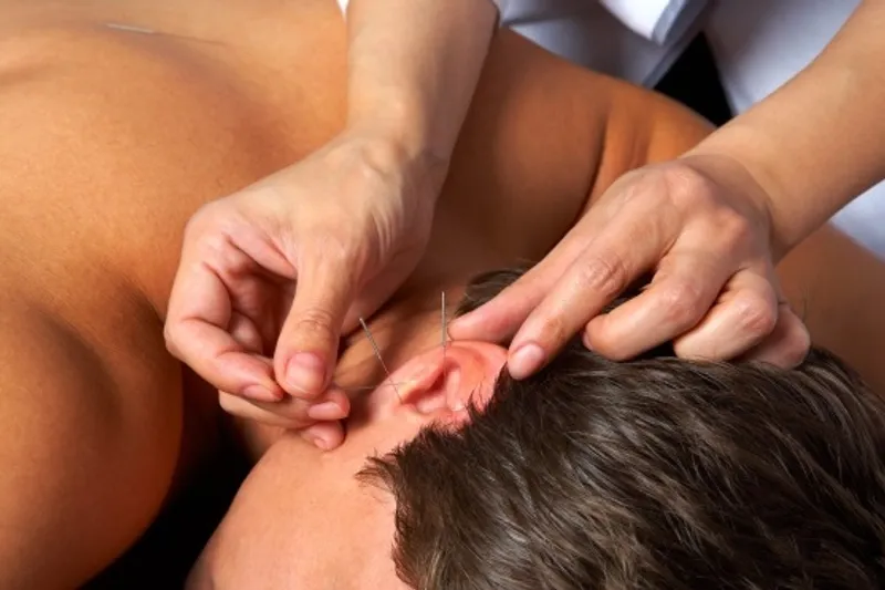 Ear acupuncture